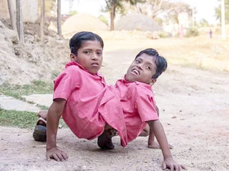 इन्हें स्कूटी चलाते देख दंग रह जाएंगे आप। एक शरीर देता है रेस तो दूसरा लगाता है ब्रेक – You will be stunned to see them running Scooty. One body gives race and the other puts  brake