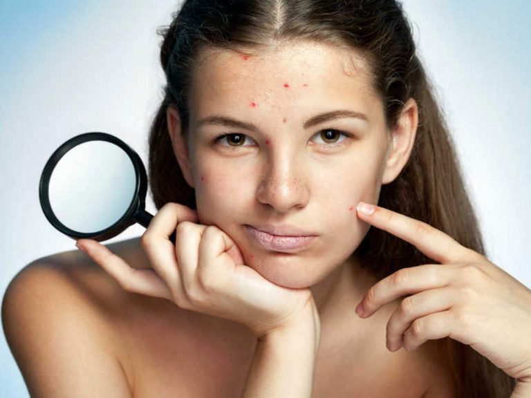 cause of pimple: आमतौर पर इन 5 वजहों से होते हैं पिंपल, जानें क्या है आपकी दिक्कत – why pimple grow on face and back