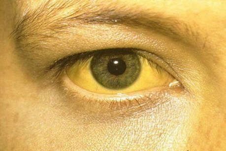 कोरोना महामारी के बीच रायपुर में पीलिया का प्रकोप, एक की मौत