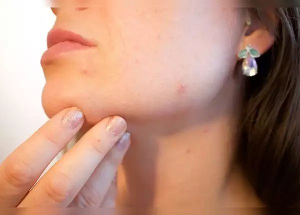 ​2. पिंपल्‍स से होता है बचाव