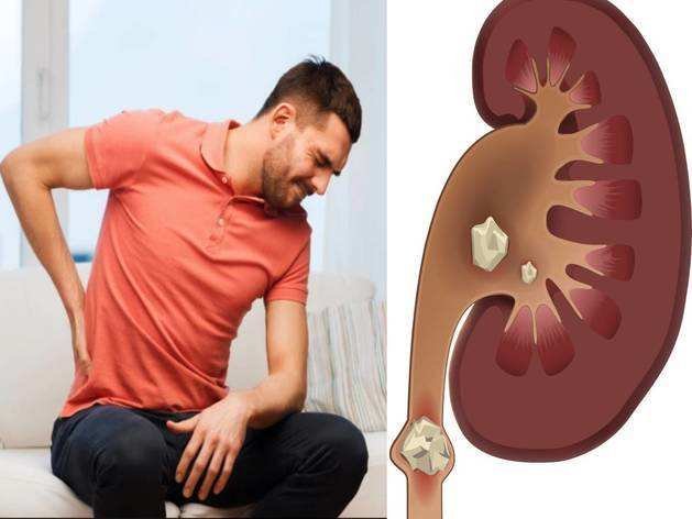 Symptoms Of Kidney Stone : बैक पेन के बाद जांच में निकले 3 किडनी स्टोन, कहीं आपको भी तो नहीं यह लक्षण