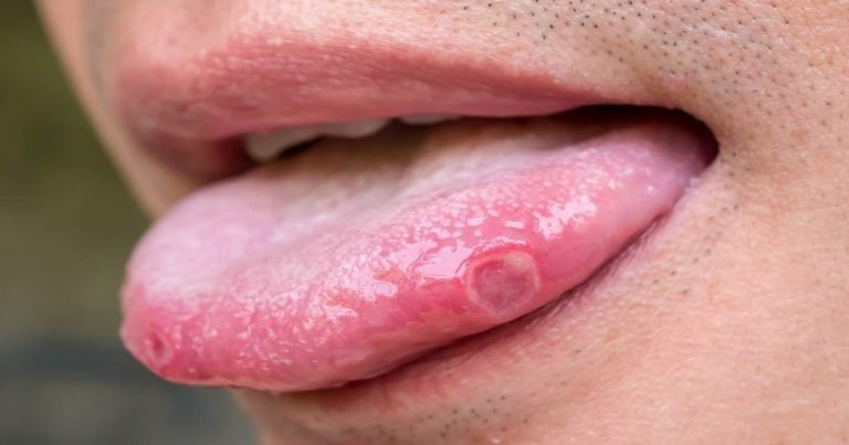 Jeebh ke chale ka gharelu ilaj: Tongue blisters home remedy