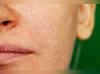 Skin care: ओपन पोर्स की प्रॉब्‍लम यूं हो जाएगी दूर, करें बस ये 3 काम 