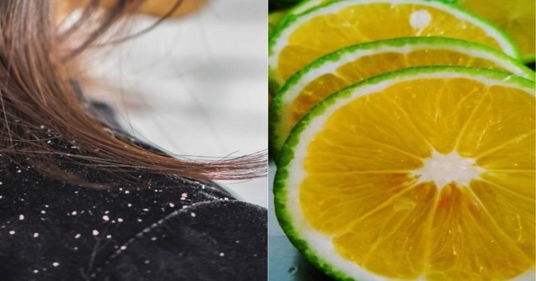 dandruff home remedies: Home Remedies: डैंड्रफ की समस्या हो तो बालों में इन 3 तरीकों से लगाएं नींबू – lemon for dandruff how to use it to keep dandruff away