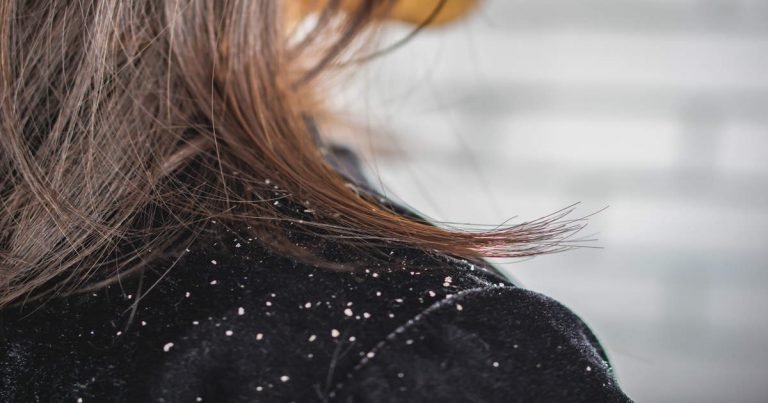 tea tree oil in shampoo: सिर पर ऐसे करें टी-ट्री ऑयल का यूज, जिद्दी से जिद्दी Dandruff की होगी छुट्टी – can tea tree oil can treat dandruff know how to use it for hair