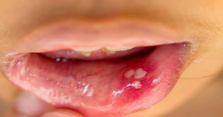 how to get rid of mouth ulcers: How To Cure Mouth Ulcer : मुंह के छालों को ठीक करने के लिए अपनाएं ये घरेलू उपचार – home remedy for mouth ulcer know how to get rid of mouth ulcers at home