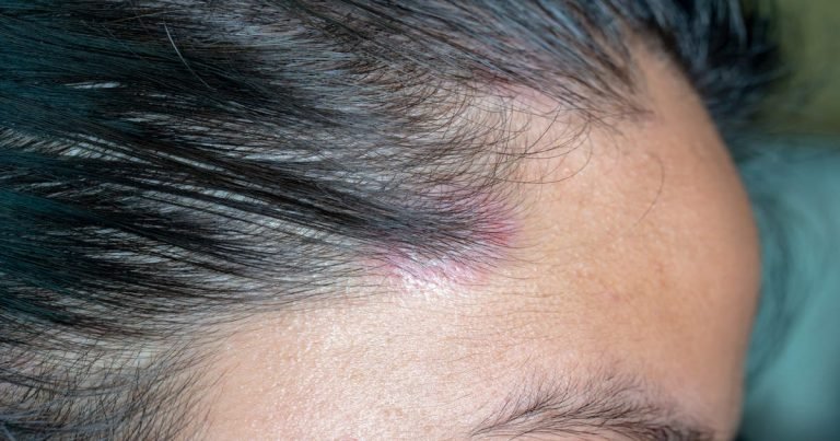 pimples on scalp: Pimples on Scalp: सिर में होने वाले मुंहासे और फुंसियों का ऐसे करें इलाज, दुबारा नहीं होगी तकलीफ – home remedies to treat scalp acne pimples in hair