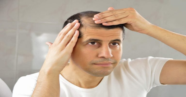 how to prevent hair loss: Hair Loss: स्ट्रेस के कारण 3 तरीकों से होता है हेयर लॉस, जानें इनके लक्षण – 3 types of hair loss due to stress