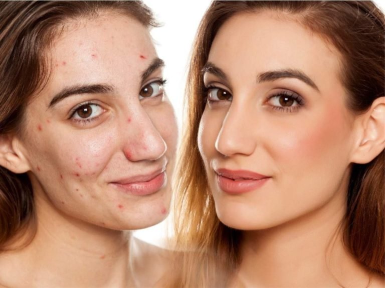 how to hide acne scars with foundation: Makeup से ऐसे छिपाएं मुंहासे के दाग धब्बे, खिला खिला नजर आएगा चेहरा – how to hide acne scars with makeup