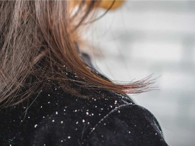 dandruff
