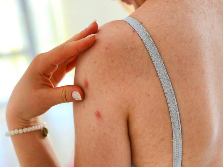 home remedies for back acne: Back Acne Reason: त्वचा पर ऐक्टिव बैक्टीरिया से होते हैं पीठ पर दाने, जानिए दूर करने के घरेलू तरीके – reasons of back acne and home remedies to cure the problem in hindi
