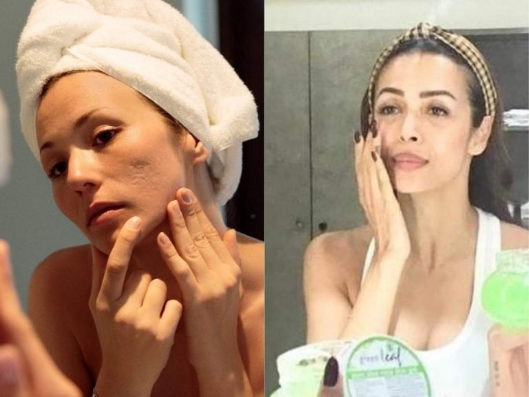 malaika arora skin care: DIY face mask: मलाइका अरोड़ा ने मुंहासे दूर करने के लिए बताया ये घरेलू नुस्‍खा, आप भी करें ट्राय – malaika arora instagram diy face mask for acne prone skin