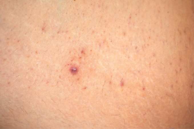 Bum Acne 1 Bum Acne 1
