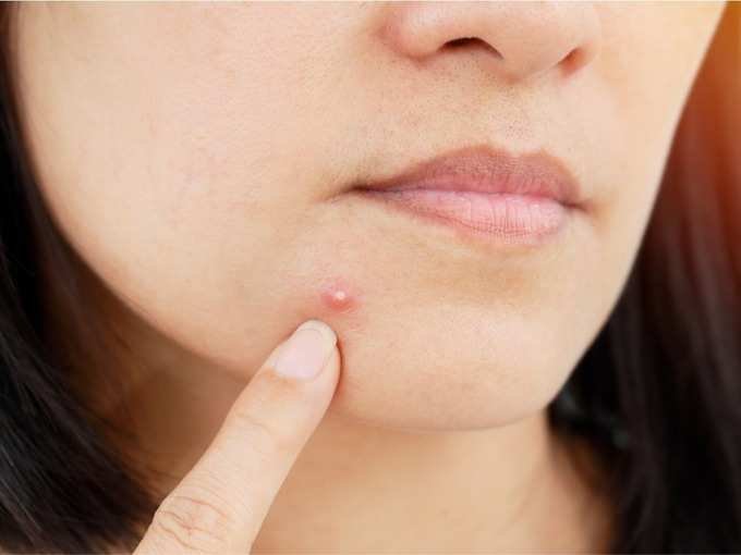 pimple pimple
