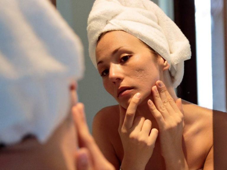 acne remedies home: Natural remedies: रातभर में दूर हो जाएंगे चेहरे के जिद्दी मुंहासे, अपनाएं ये DIY होम रेमिडीज – 5 genius overnight diy remedies for acne