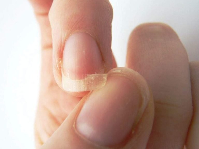 Nails Care tips: क्यों पीले-पीले रहते हैं आपके नाखून और क्या है इनके टूटने की वजह? – how to remove yellowing of the nails what to eat for healthy nails