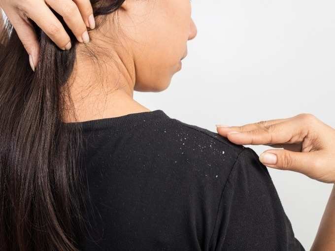 dandruff1 dandruff1