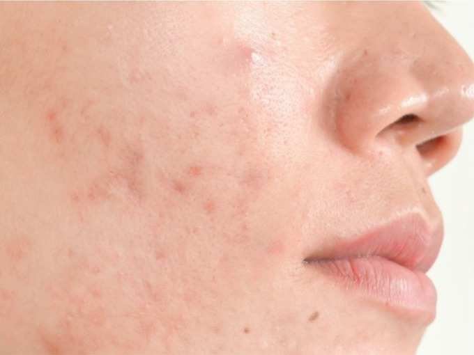 pimples (1) pimples (1)