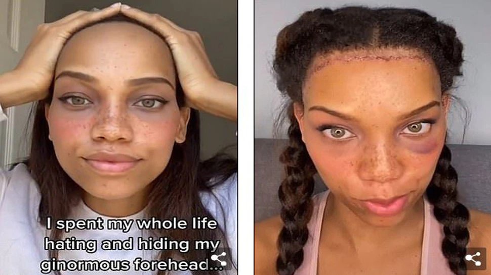 Lady spent almost 5 lakhs on surgery to reduce her forehead by 3 cm | महिला ने अपने माथे की सर्जरी करवा साइज कराया छोटा, आया इतना खर्च