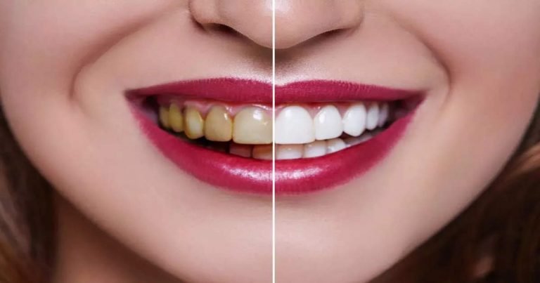 us based nutritionist rodriguez suggest hydroxyapatite toothpaste is best way to make your teeth strong and white – How to whiten teeth naturally: अमेरिकी Nutritionist ने बताया पीले दांतों को सफेद करने का आसान उपाय, Cavities से भी होगा बचाव