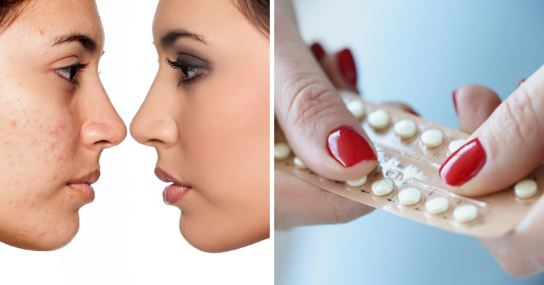 birth control pills for acne, मुंहासों के लिए गर्भनिरोधक गोलियां खाना कितना सुरक्षित है? जानें डॉक्टर का क्या है कहना – is it safe to take birth control pills for acne treatment doctor rashmi shetty reveals the truth
