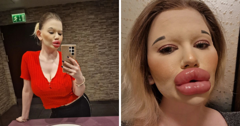 World’s Biggest Lips Andrea Ivanova lip fillers, इस महिला के होंठ हैं दुनिया में सबसे बड़े, साइज इतना कि नाक से सांस लेना भी है मुश्किल – bulgarian woman andrea ivanova has biggest lips after hyaluronic acid lip fillers know more about it