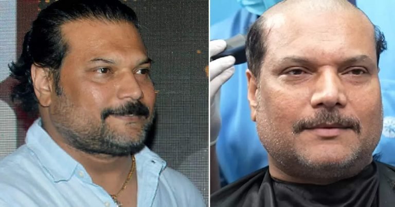 CID’s Dayanand Shetty Hair Transplant