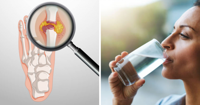 Remedies For High Uric Acid: खून में कितना होना चाहिए यूरिक एसिड का लेवल? इन 5 तरीकों से घर पर करें कंट्रोल – home remedies for uric acid higher level can cause kidney and heart disease